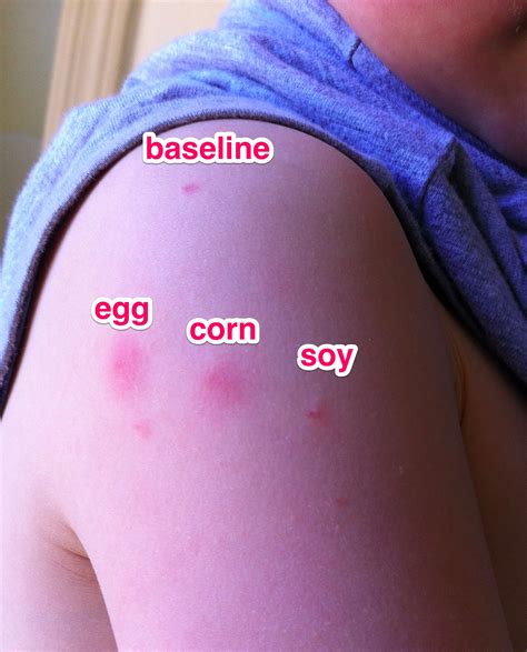 It's actually very difficult to categorically state that a particular rash is a result of an allergy to food, as food allergies can cause different types of rashes. Michelle Schwartz's Food Workshop » Autistic for a Day
