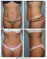 Images of Insurance Cover Abdominoplasty