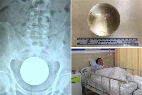 Man 31 Gets Three Inch Wide Glass Ball Stuck In His Rectum After Inserting It Into His Bum To