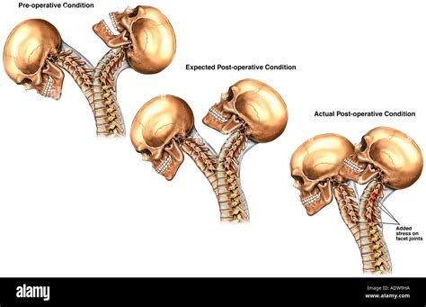 Cervical Spine Range Of Motion Chart