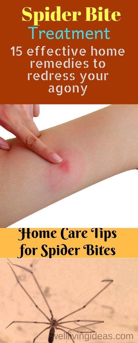 15 Home Remedies To Treat A Spider Bite Quickly At Home Spider Bites