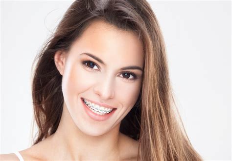 How To Look Your Best With Braces Diva Likes