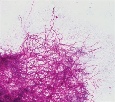 Partially Acid Fast Gram Positive Bacilli Grew From Resected Adrenal
