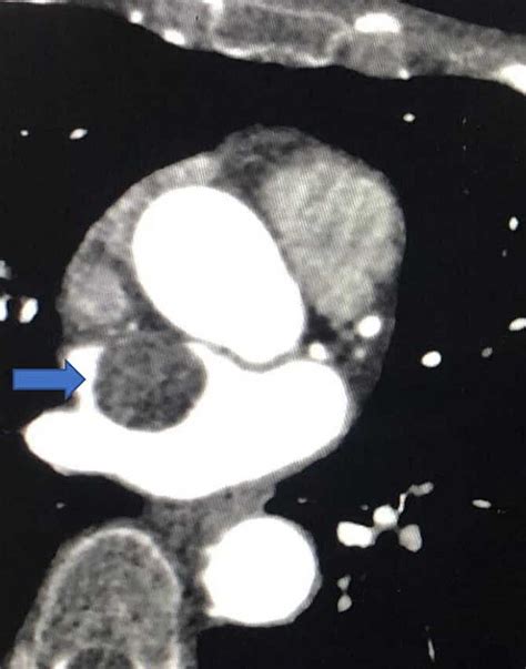 Cureus A Case Report On The Incidental Diagnosis Of A Left Atrial