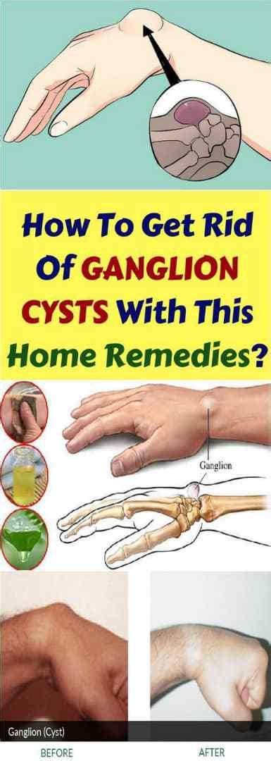 How To Get Rid Of Ganglion Cyst In Knee Damian Moore Kapsels