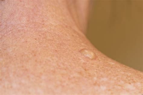 Warts Skin Tags Common Skin Growths Dermatologist In Karachi Dr