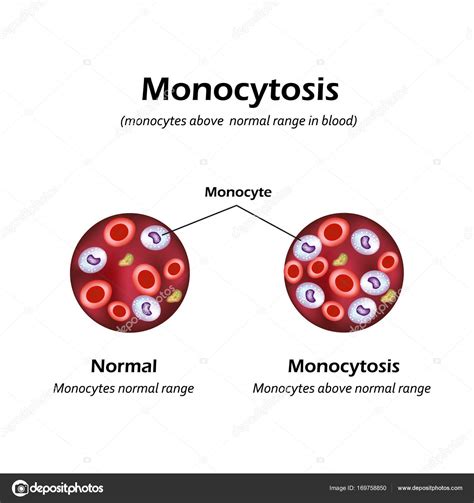 Monocytes Above The Normal Range In The Blood Monocytosis Vector