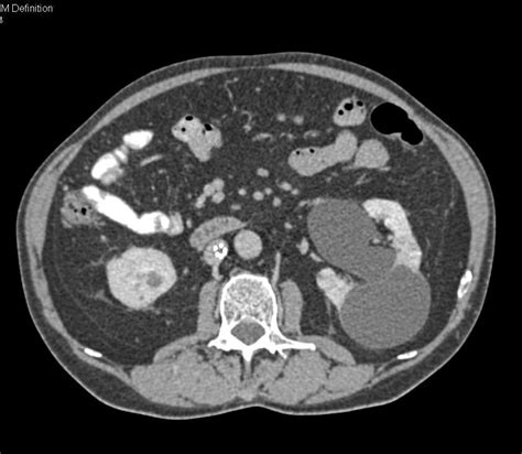 Bilateral Renal Cysts And Carcinoma Of The Distal Left Ureter Kidney