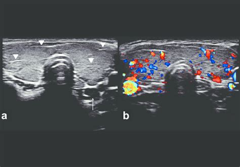 Abnormal Thyroid Ultrasound