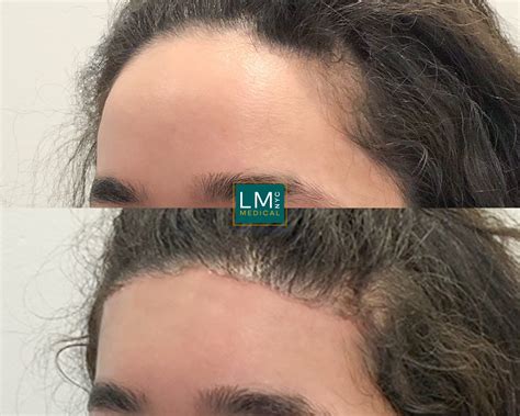 Hair Transplant And Hairline Lowering Before And After Gallery Lm