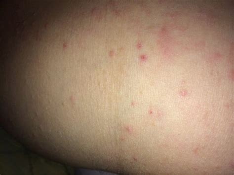 Extremely Itchy Rash Pic Included May Be Tmi Babycenter