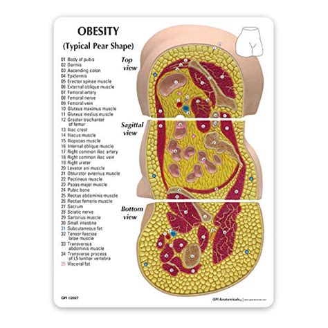 Buy Obesity Model Human Body Anatomy Replica Of Overweight Body Types