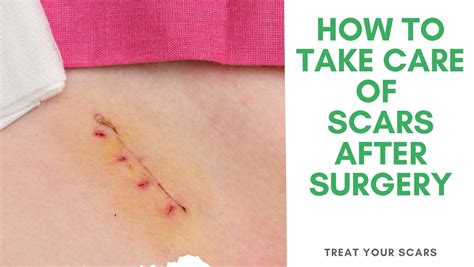 How To Take Care Of Scars After Surgery Treat Your Scars