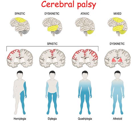 Surgery For Children With Cerebral Palsy When And How It Helps Mya Care