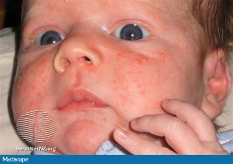 5 Things To Know About Pediatric Acne