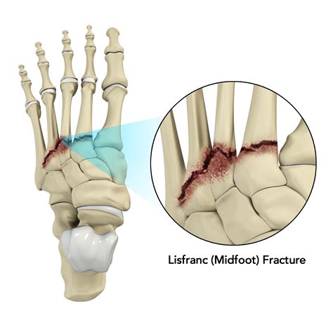 Lisfranc Fracture Treatment Pasadena Midfoot Injury La Canada Ca