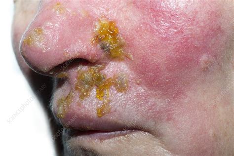 Shingles Rash On The Face Stock Image C0213417 Science Photo Library