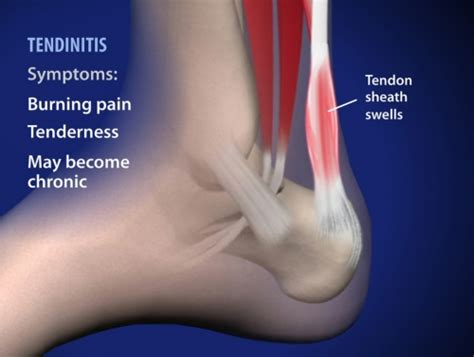 Achilles Tendonitis Pain Symptoms Denver Co Doctors Top Treatments