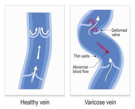 What Should I Know About Vein Valves And Healthy Blood Flow
