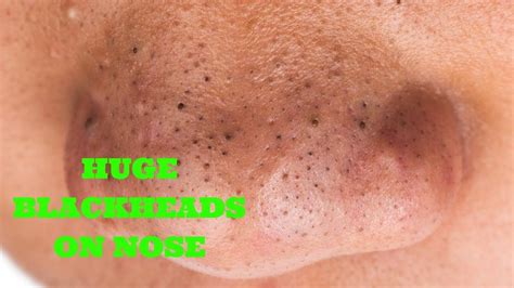 Pull Out Blackheads On Nose Close Up 50x Blackhead Removal Youtube