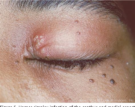 Figure 1 From Differential Diagnosis Of The Swollen Red Eyelid