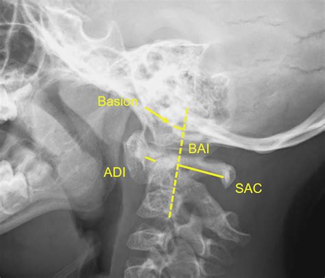 Cureus The Association Between Radiographic And Mri Cervical Spine