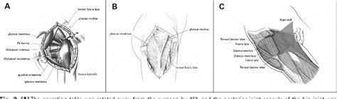 Figure 2 From Total Hip Arthroplasty Using A Combined Anterior And Posterior Approach Via A