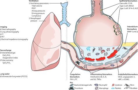 Acute Respiratory Distress Syndrome The Lancet