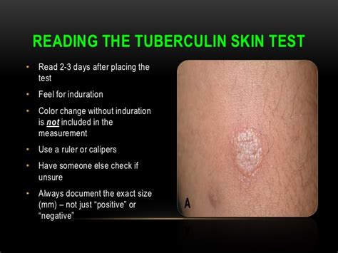 Tb Skin Test Pictures