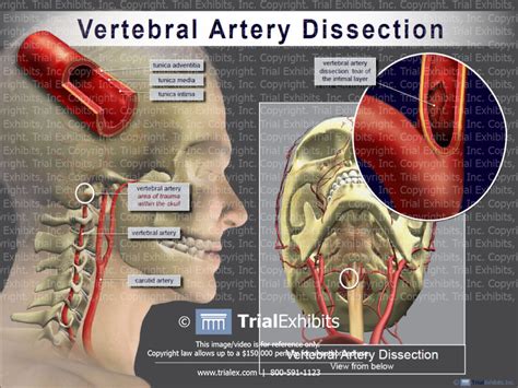 Vertebral And Carotid Artery Dissection Wikem SexiezPicz Web Porn