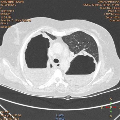 Showing Cect Scan Of The Chest Showing Bilateral Lung Abscesses