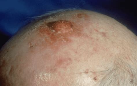Squamous Cell Carcinoma Diagnosis Risks Treatment And Prevention