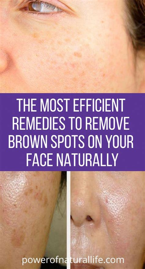 Ways To Take Out Brown Spots On Experience Whatcausesbrownspotsonface