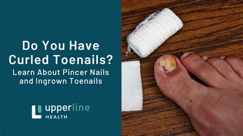 Curled Toe Nails All About Pincer Nails And Ingrown Toenails