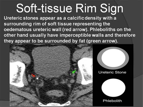Soft Tissue Rim Sign Bilateral Calcific Densities Near The Vuj Right