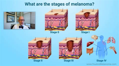 What Are The Stages Of Melanoma Youtube