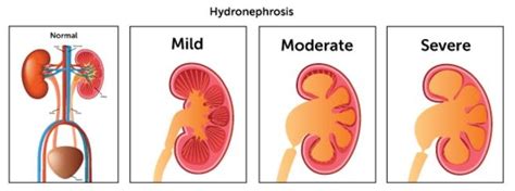 Hydronephrosis Definition What Is Symptoms Treatment Causes