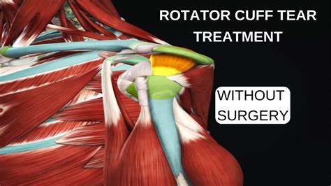 Rotator Cuff Tear Treatment Without Surgery YouTube
