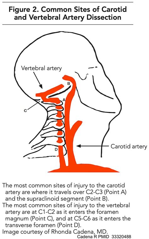 Preventing Stroke After Cervical Artery Dissection Cr
