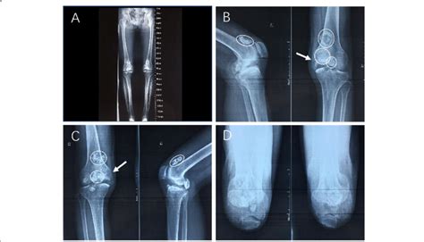 Preoperative Plain Radiographs A Anteroposterior Radiographs Of The