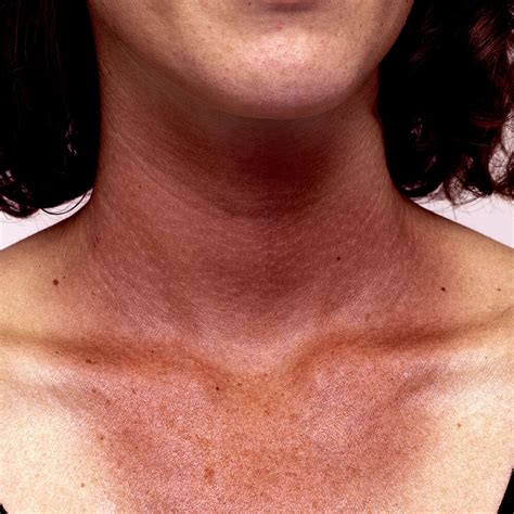 Sun Damage — Virginia Square Dermatology Isabela Jones Md