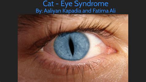 Cat Eye Syndrome By Aaliyan Kapadia