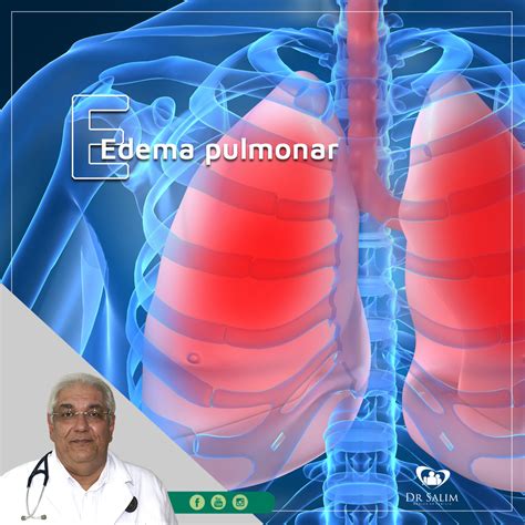 Edema Pulmonar Agudo Sintomas Causas E Tratamento Images And Photos
