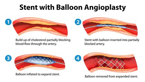 Acute Myocardial Infarction Stepwards