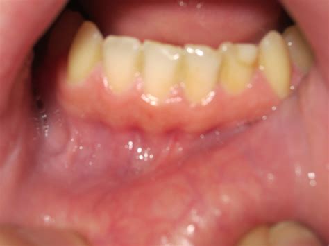 Small Patches On Gums