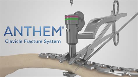 Anthem® Clavicle Fracture System Justin Land Online