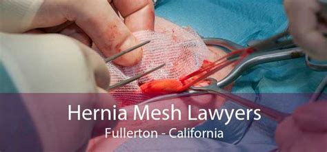 Hernia Mesh Lawyers Fullerton Best Lawyer For Hernia Mesh Lawsuit