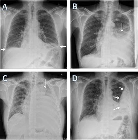 Pleural effusion develops when more fluid enters the pleural space than is removed. The modern diagnosis and management of pleural effusions | The BMJ