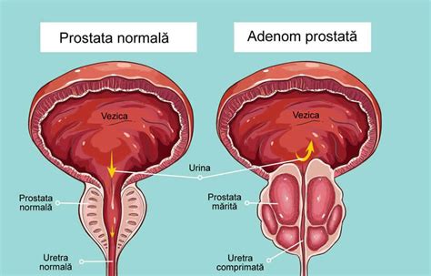 Adenomul De Prostata Prostata Marita Simptome Tratament