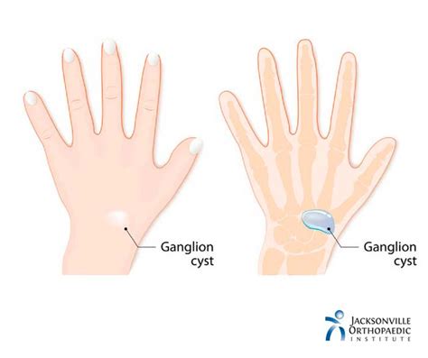 Causes And Treatment Of Ganglion Cyst Geniuspharm